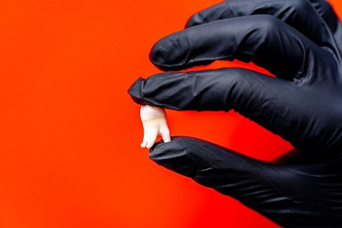 Tooth Extraction